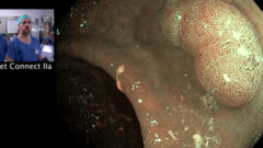 Définition des lésions qui relèvent d’une exérèse endoscopique dans une MICI