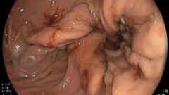 CURRICULUM D’ENDOSCOPIE BARIATRIQUE : INSCRIPTIONS CLOSES