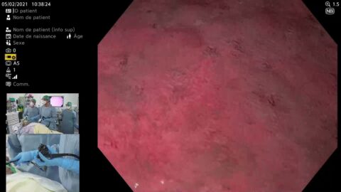 Cartographie gastrique et résection d'un polype de l'antre