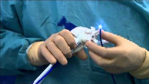 Cholangioscopie par SpyGlass