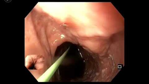 Dilatation pneumatique pour achalasie chez un patient présentant des varices œsophagiennes