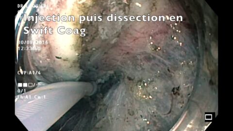 Dissection sous-muqueuse d'une Laterally Spreading Tumor rectale de 4 centimètres