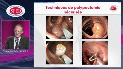 Endoscopie digestive et nouveaux anticoagulants oraux (vidéo)