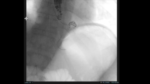 Hématome surinfecté de l'œsophage post-POEM