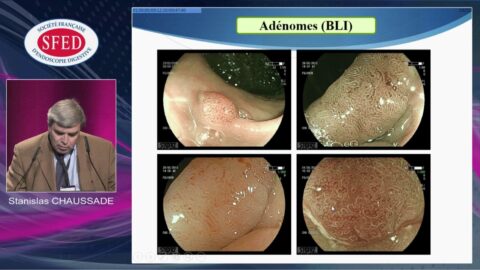 Les petits polypes colo-rectaux : caractérisation ; faut-il tous les réséquer et les faire analyser ? (vidéo)