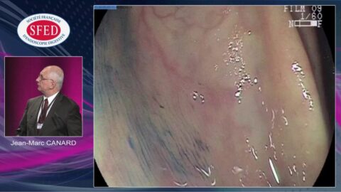 Les petits polypes colo-rectaux : conclusion ; impact médico-économique (vidéo)