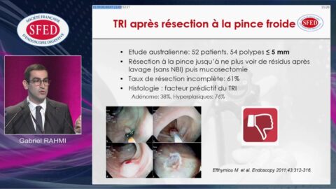 Les petits polypes colo-rectaux : techniques de résection (vidéo)