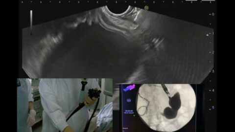 Reperméabilisation gastro-gastrique pour CPRE chez une patiente avec un by-pass