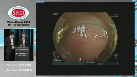 Résections coliques difficiles (vidéo)