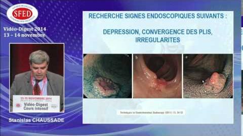 Risque de cancérisation des polypes : comment le reconnaître au cours de l'examen endoscopique ? (vidéo)