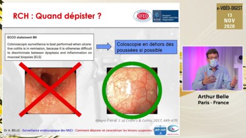 Symposium professionnel "Surveillance endoscopique des MICI" (vidéo)