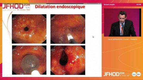 Traitement des sténoses intestinales (vidéo)