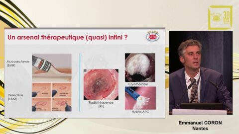 Traitement endoscopique de l'endobrachyoesophage (vidéo)