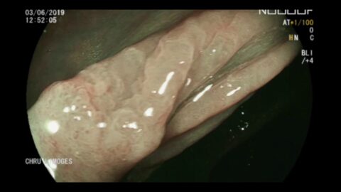 Traitement endoscopique des hémorragies digestives : penser à utiliser la gravité !