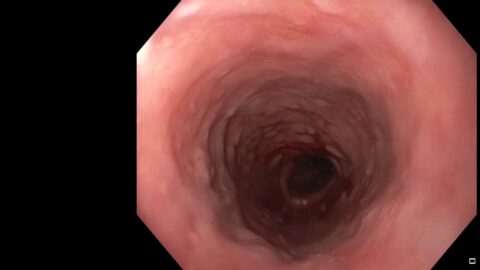Une œsophagite atypique