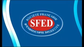 Mucosectomie de tumeurs villeuses coliques