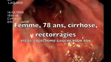 Sclérose au cyanoacrylate d'une varice ectopique après anastomose recto-colique