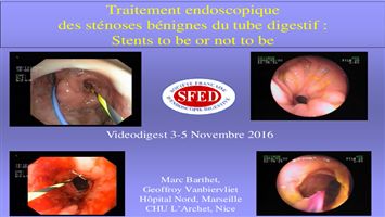 Traitement endoscopique des sténoses bénignes du tube digestif : stents to be or not to be