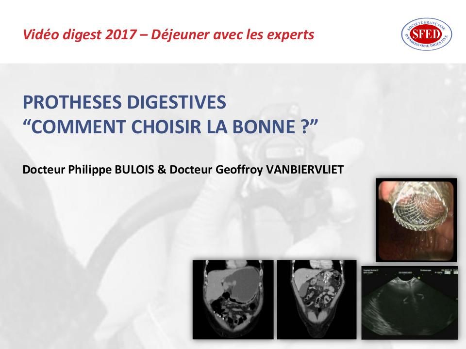 Prothèses digestives : comment choisir la bonne ?
