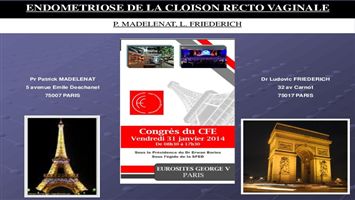 Endométriose de la cloison recto-vaginale