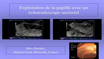 Exploration de la papille avec un écho-endoscope sectoriel