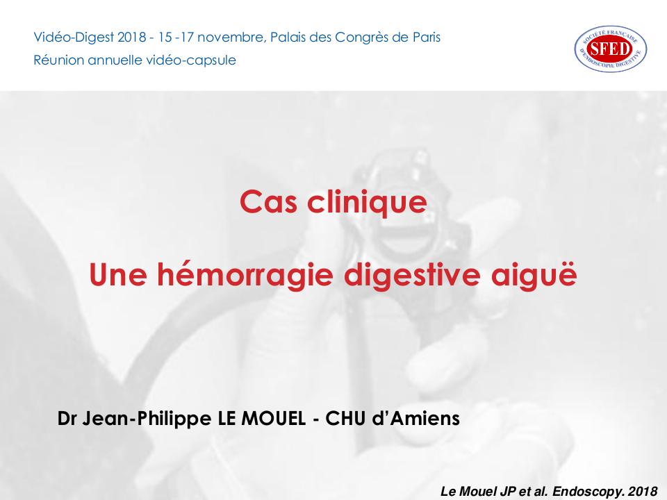 Cas clinique sur un diverticule de Meckel