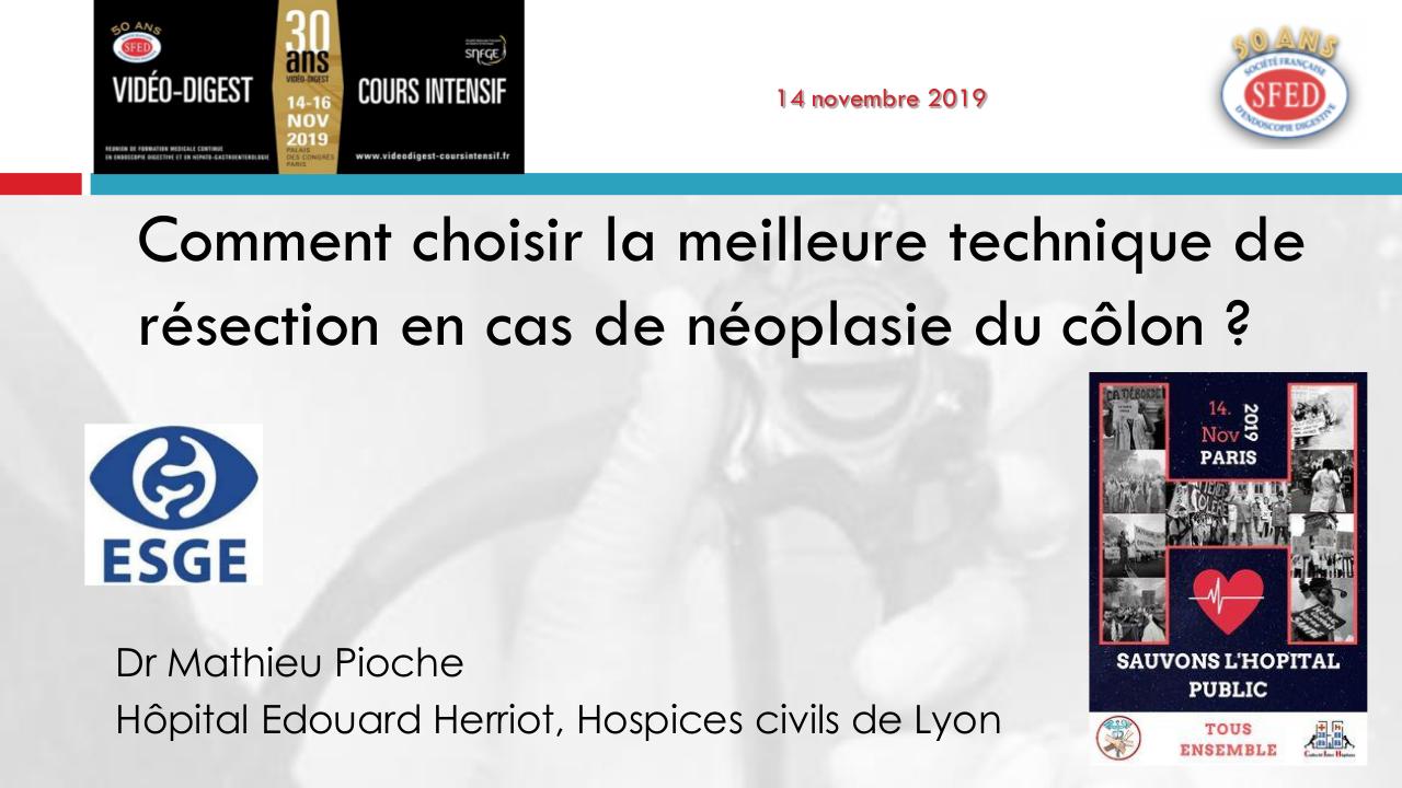 Comment choisir la meilleure technique de résection en cas de néoplasie du côlon ?