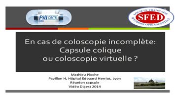 En cas de coloscopie incomplète : vidéo-capsule colique ou coloscopie virtuelle ?