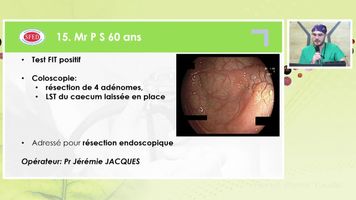 RESECTION ENDOSCOPIQUE