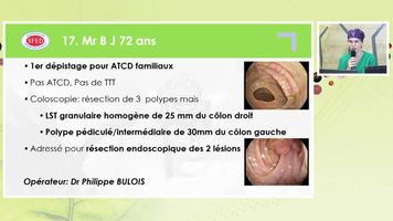 RESECTION ENDOSCOPIQUE DE DEUX LESIONS