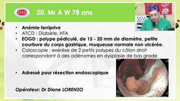 RESECTION ENDOSCOPIQUE