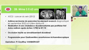 GASTRO-ENTEROANASTOMOSE ECHOENDOSCOPIQUE