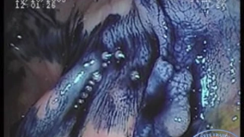 Adénome colique plan après coloration à l'indigo-carmin