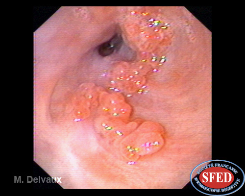 Condylome œsophagien – SFED