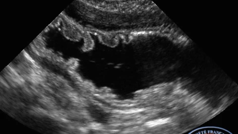 Fundus normal