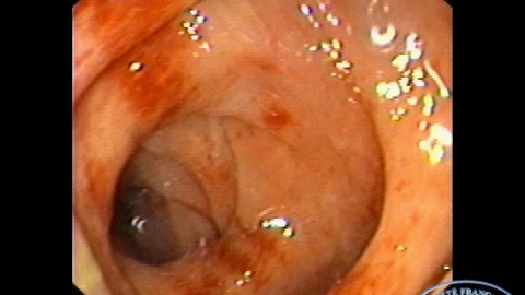 Granulome sur agrafe d'anastomose recto-colique