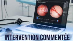 Dissection sous muqueuse d’une lésion caecale